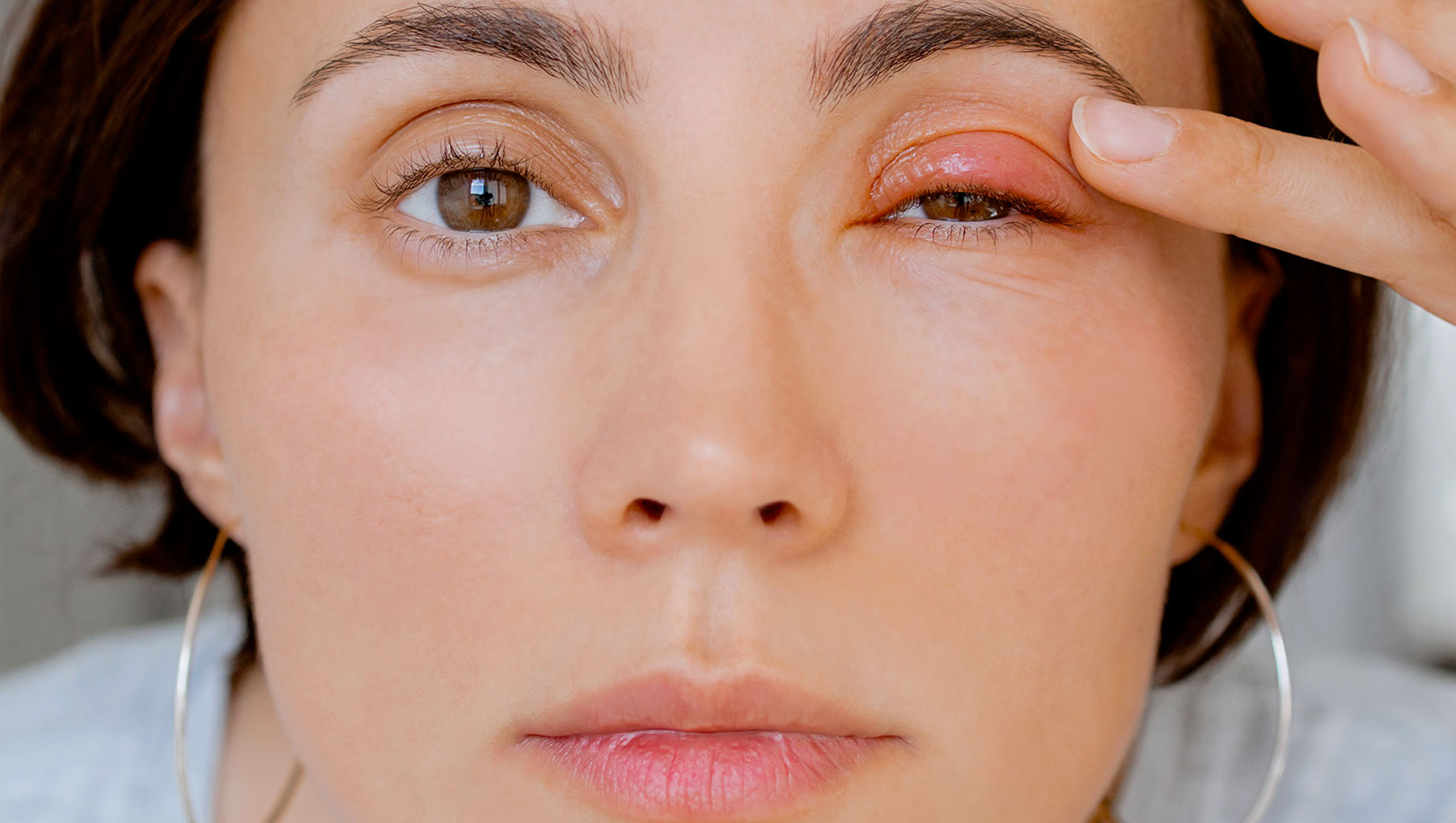 Comprendre et traiter le Chalazion