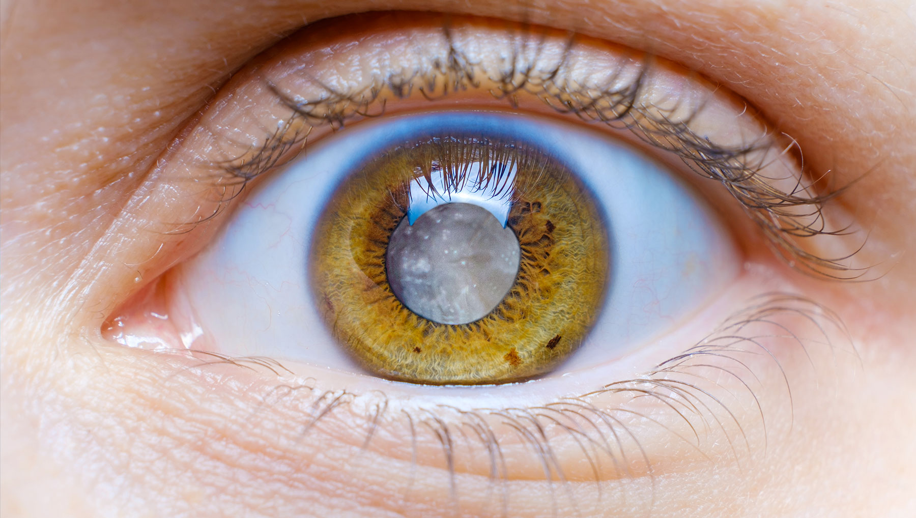 Tout savoir sur la Cataracte