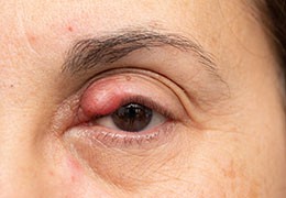 Gestion et Traitement du Chalazion : Conseils et Suivi